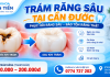 Trám Răng Sâu Tại Cần Đước – Giá Trám Răng 2026