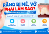 Răng Bị Mẻ, Vỡ Phải Làm Sao? Giá Trám Và Bọc Sứ 2026