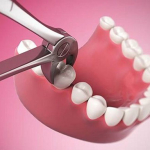 Dịch Vụ Nhổ Răng 