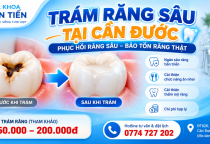 Trám Răng Sâu Tại Cần Đước – Giá Trám Răng 2026