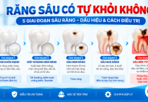 Răng Sâu Có Tự Khỏi Không? Các Giai Đoạn Sâu Răng Và Cách Điều Trị