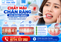 Chảy Máu Chân Răng Khi Đánh Răng – Nguyên Nhân, Cách Xử Lý Và Khi Nào Cần Đi Khám?