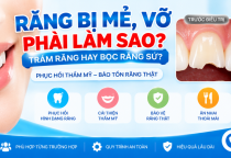 Răng Bị Mẻ, Vỡ Phải Làm Sao? Giá Trám Và Bọc Sứ 2026