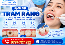  Trám Răng Tại Cần Đước – Trám Răng Sâu, Răng Mẻ, Bảng Giá