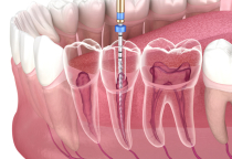 Dịch Vụ Nội Nha (Chữa Tủy)