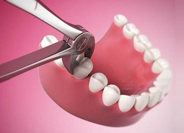 Dịch Vụ Nhổ Răng 