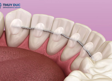 Dịch Vụ Cố Định Hàm 