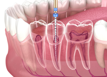 Dịch Vụ Nội Nha (Chữa Tủy)