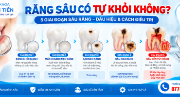 Răng Sâu Có Tự Khỏi Không? Các Giai Đoạn Sâu Răng Và Cách Điều Trị