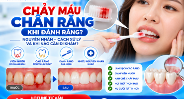 Chảy Máu Chân Răng Khi Đánh Răng – Nguyên Nhân, Cách Xử Lý Và Khi Nào Cần Đi Khám?