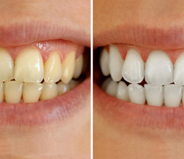 Kinh Nghiệm Tẩy Trắng Răng Tại Nhà Hiệu Quả Từ Nha Khoa Tân Tiến