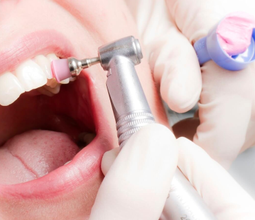 Kinh Nghiệm Cạo Vôi Răng Và Đánh Bóng Răng – Bí Quyết Cho Nụ Cười Tươi Tại Nha Khoa Tân Tiến