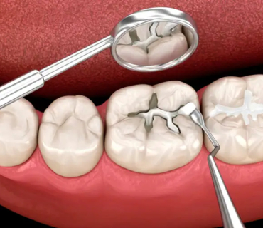 Kinh Nghiệm Trám Răng Từ Nha Khoa Tân Tiến