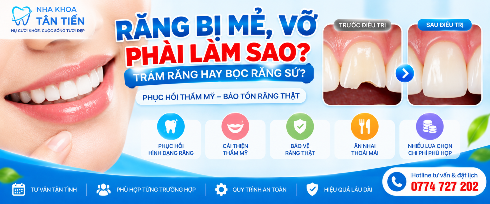 Răng Bị Mẻ, Vỡ Phải Làm Sao? Giá Trám Và Bọc Sứ 2026