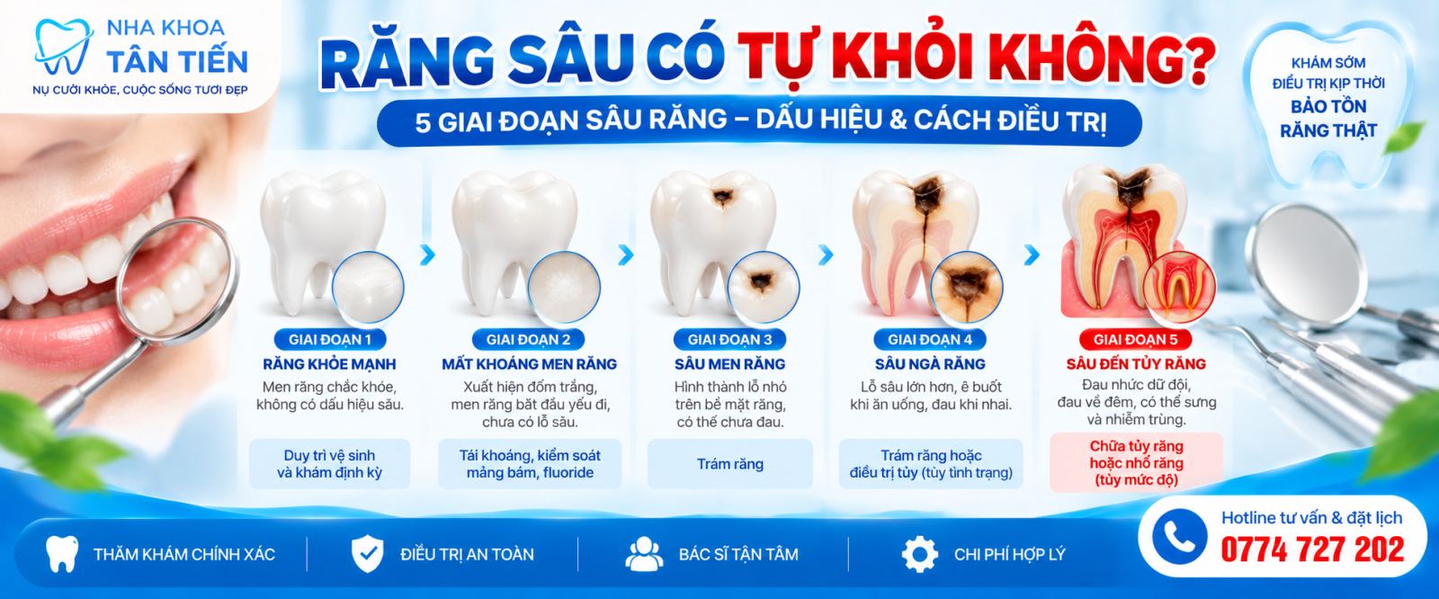 Răng Sâu Có Tự Khỏi Không? Các Giai Đoạn Sâu Răng Và Cách Điều Trị